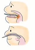 鼻から入れる内視鏡の特徴